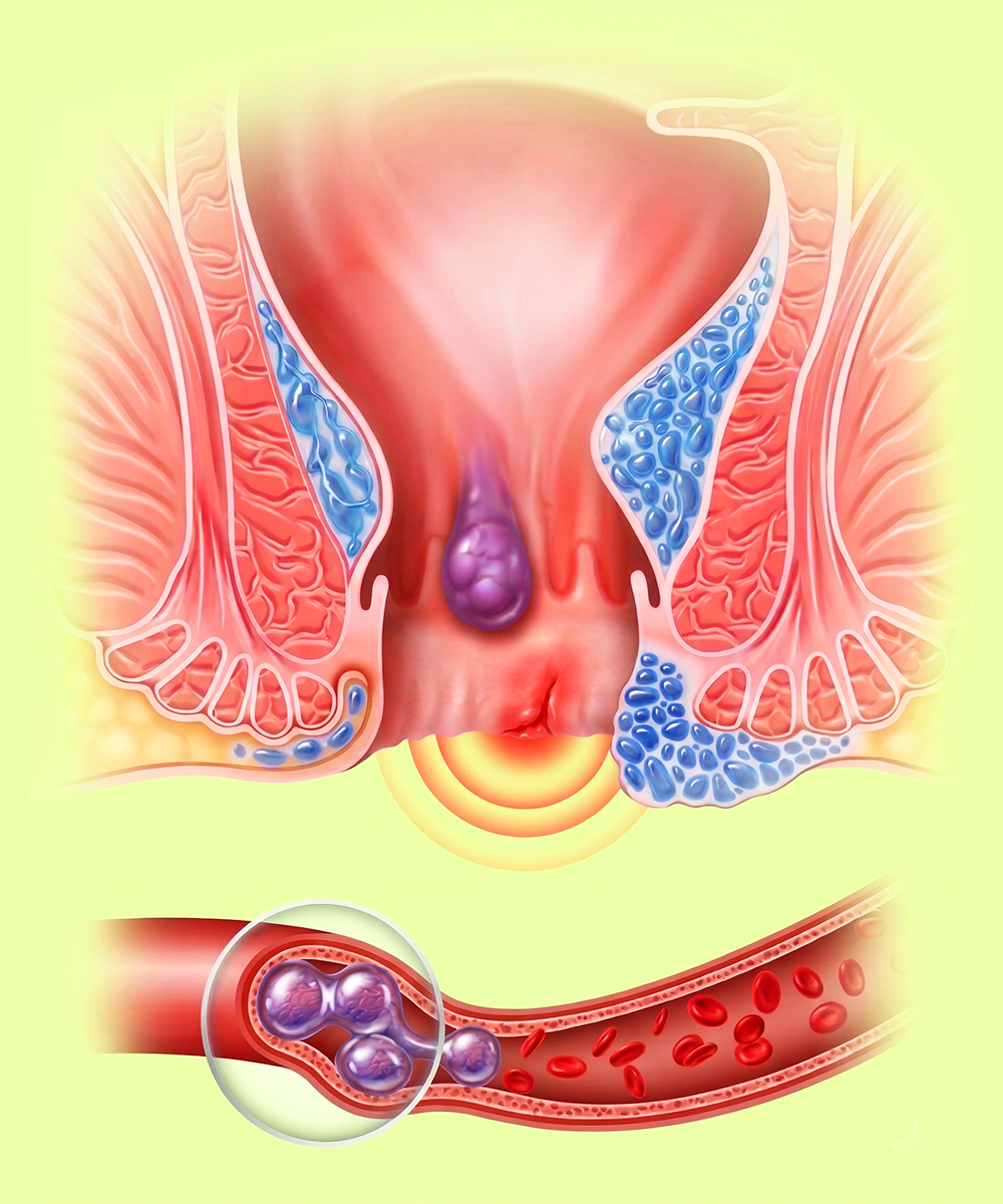 Persistent discomfort visualization
